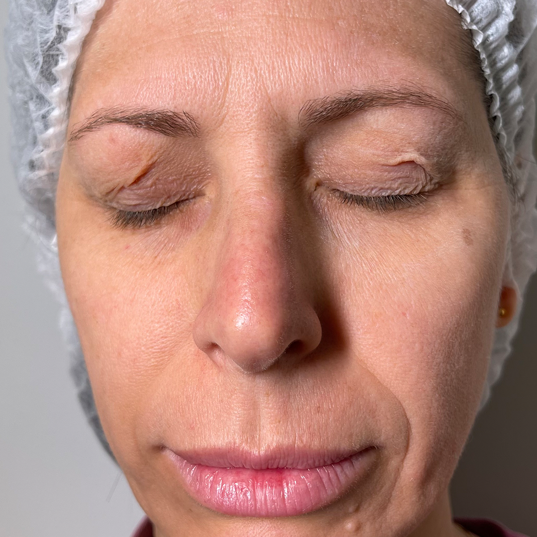 antes-antes antes-antes